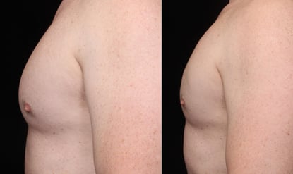 Cosmedica Victoria CoolSculpting Before and After Chest