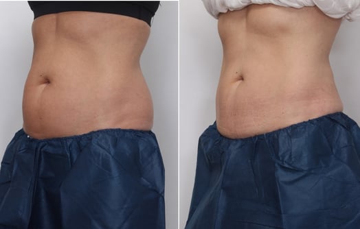 Cosmedica Victoria CoolSculpting Before and After Tummy Abdomen Love Handles