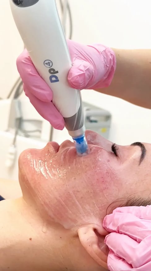 microneedling