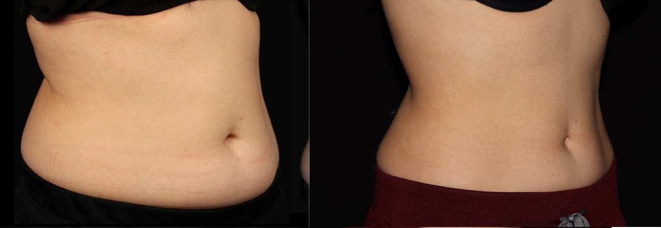 coolsculpting victoria bc before and after