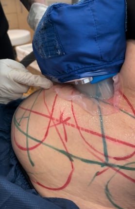 coolsculpting-applicator-attached-to-marked-abdomen-with-gel-pad-and-gloved-hands