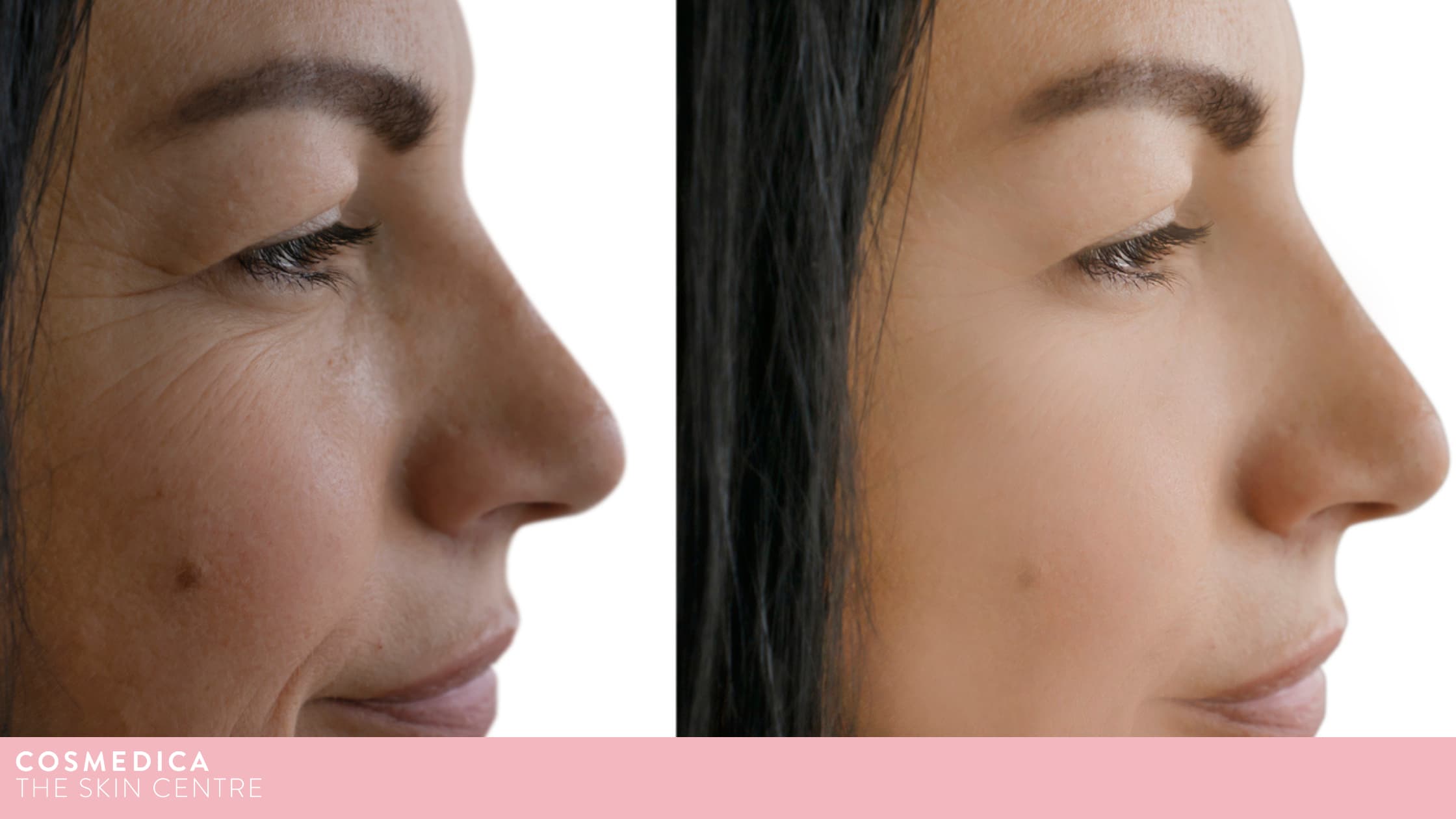 cosmedica thermage before and after -