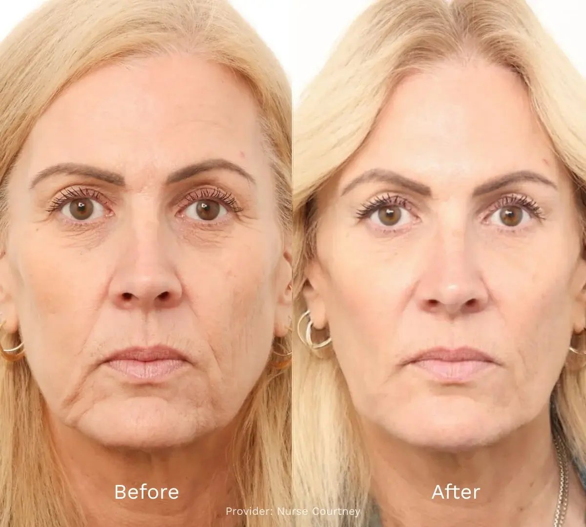 photo-side-by-side-facial-balancing-before-and-after-woman-with-blonde-hair-neutral-expression-studio-lighting-earrings-visible-provider-text-nurse-courtney