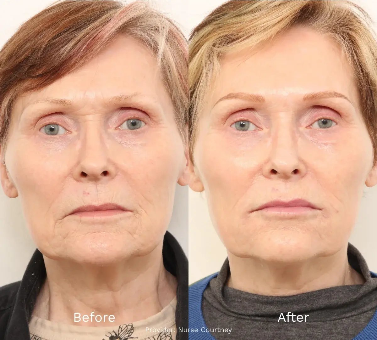 photo-side-by-side-facial-balancing-before-and-after-woman-with-short-hair-neutral-expression-studio-background-provider-text-nurse-courtney