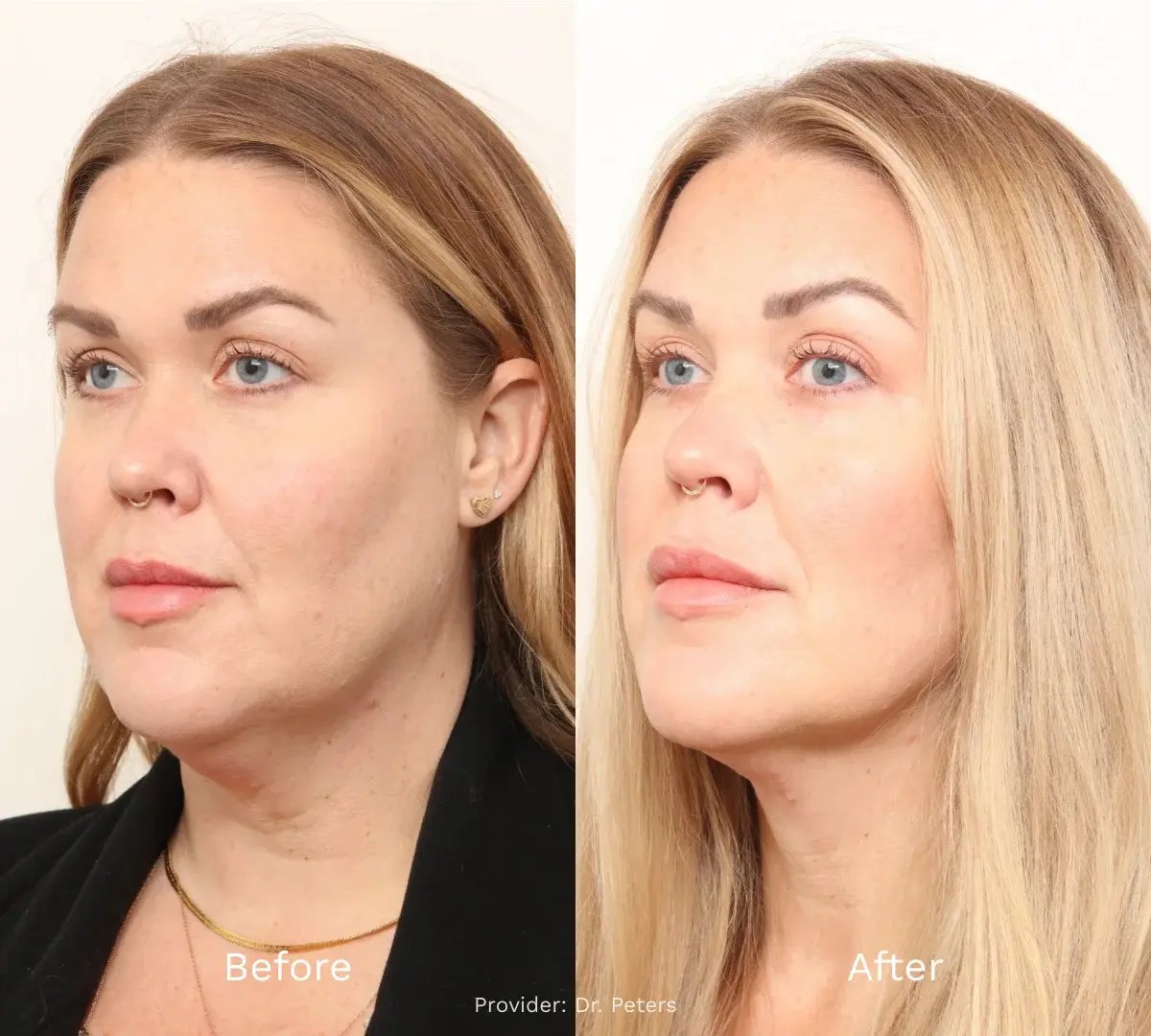 photo-side-by-side-woman-profile-before-and-after-blonde-hair-nose-ring-earrings-necklace-provider-text-dr-peters-1