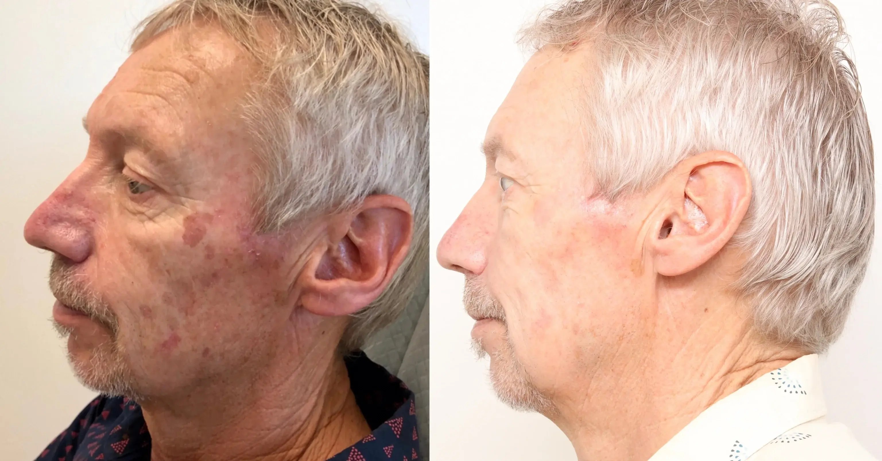 side-by-side-before-and-after-photos-of-an-older-man-showing-improved-skin-clarity-and-reduced-pigmentation-on-his-face