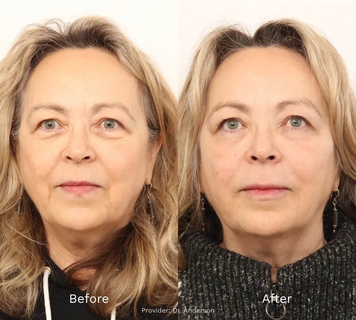 side-by-side-before-and-after-portrait-of-woman-showing-smoother-skin-and-subtle-facial-refinement