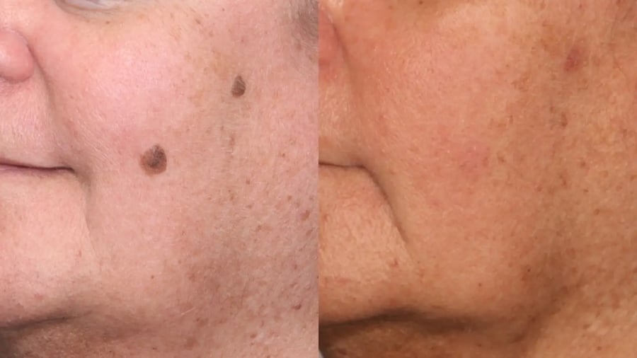 Mole Removal Before and After Pictures