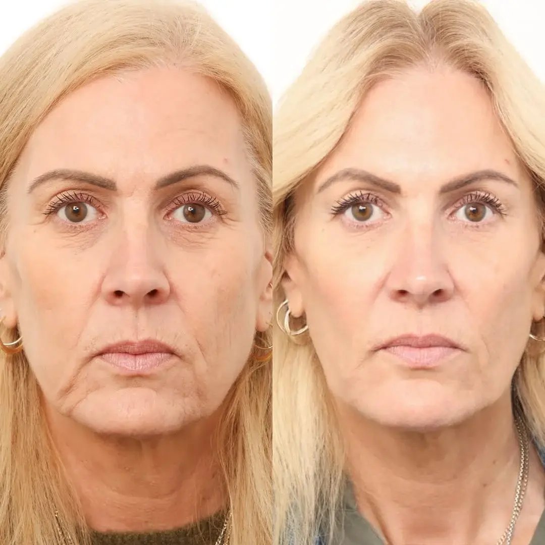 side-by-side-comparison-of-a-woman-before-and-after-facial-harmonization-showing-smoother-skin-improved-facial-balance-and-more-even-complexion