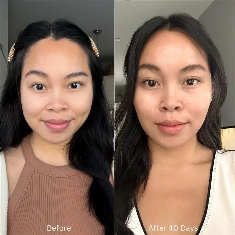 side-by-side-images-of-a-woman-showing-morpheus8-before-and-after-40-days-with-smoother-brighter-skin