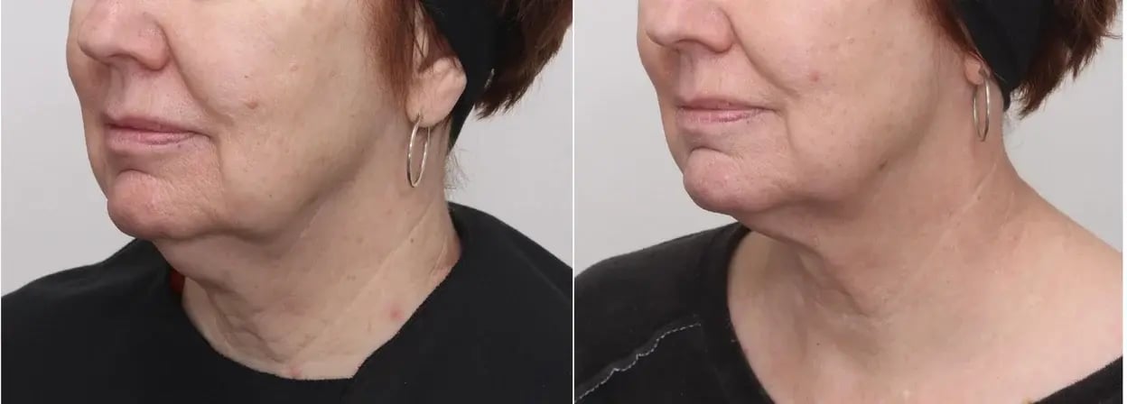 side-by-side-profile-of-woman-jawline-before-and-after-coolsculpting-before-and-after-showing-reduced-under-chin-fullness-and-smoother-neck-contour