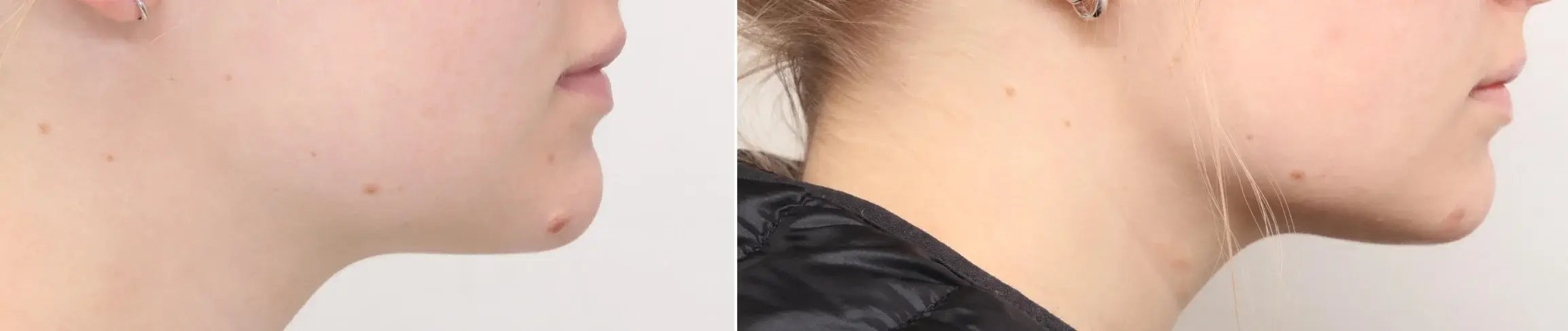 side-profile-of-chin-and-neck-showing-small-mole-before-and-clear-skin-after-mole-removal-before-and-after-treatment